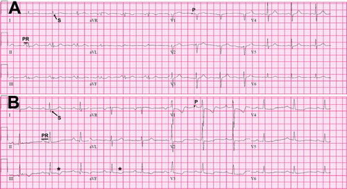 Figure 1.  Electrocardiographic characteristics of COPD patients without and with PH.Panel A corresponds to the ECG of a COPD patient without PH (mean PAP 17 mm Hg, heart rate 81 bpm, PR interval 124 ms, QRS complex duration 76 ms, QTc interval 401 ms, QRS axis + 37° and T wave axis + 70°). Panel B shows the ECG of a COPD patient with PH (mean PAP 65 mmHg, heart rate 63 bpm, PR interval 216 ms, QRS complex duration 84 ms, QTc interval 409 ms, QRS axis + 72° and T wave axis – 22°). In the ECG of the COPD patient with PH (panel B) the PR interval (PR) is longer, the P wave (P) in V1 and the S wave in lead I are of larger amplitude. In addition, there are negative T waves in the inferior leads (*).