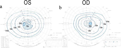 Figure 6. Goldmann kinetic visual field test of the patient with MIDD