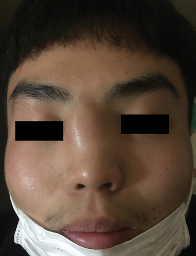 Figure 1. A local bulge on the dorsum of the nose upon admission.