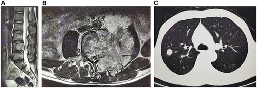 Figure 1 (A and B) MRI of lumbar spine displayed partial cortical bone destruction and formation of abscesses at L4. (C) A chest CT scan demonstrated small round nodules with uneven density of upper right lung. The red arrow represents lesion.