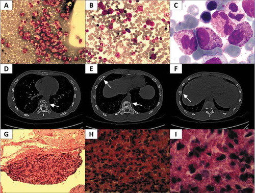 Figure 1. Summary of CT scan and pathological assessment. A Image of Wright stained peripheral blood smear (200x); a large number of eosinophils (red) were observed. B-C Wright-Giemsa stained bone marrow smear (B, 200x; C, 1000x); a large amount of orange eosinophil was observed. D-F Pictures of CT scans at different heights. In D, osteolytic lesions were observed in vertebrae (arrow); E reveals osteolytic lesions in a rib and the vertebrae (arrows); in F, osteolytic lesions were found in another rib (arrow). G-I Pictures of tenderness area rib biopsy stained with hematoxylin/eosin (G, 100x; H, 400x; I, 1000x), numerous orange or red eosinophils were observed.