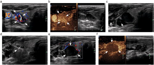 Figure 1. Ultrasound image of hyperplastic parathyroid gland before and after radiofrequency ablation (RFA). (a) Color doppler ultrasound (US) examination reveals a solid nodule (arrow) presence of abundent flow signals before RFA; (b) The hyperplastic parathyroid gland presents hyperenhancement (arrow) in the arterial phase at preablation contrast-enhanced US examination; (c) Hydrodissection technique (arrow) is applied in the RFA procedure to protect the critical structures from thermal injury; (d) After starting ablation, hyperechoic zone (arrow) was observed surrounding radiofrequency electrode; At the end of ablation, (e) no obvious blood flow signal (arrow) displays intra-gland, and (f) non-enhanced zone (arrow) covers the whole ablated gland on US imaging.