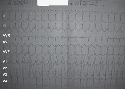 Fig. 2. Electrocardiogram of the first patient four hours after admission showed an increase of ST-segment in the leads V1 and V2.