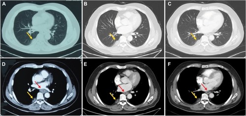 Figure 1 Changes in CT in the ESCC.Notes: (A and D) the well-circumscribed mass in right pleura (yellow arrows) and thickened esophageal wall (red arrow) prior to treatment, respectively. (B and E) Reduction in the lesions for the esophageal wall (red arrow) and stabilization of the lesion for the right pleura (yellow arrows) after two cycles of TP chemotherapy. (C and F) Esophageal wall (red arrow) thickness decrease and pleural lesion (yellow arrows) size stability after four cycles of TP chemotherapy.Abbreviations: CT, computed tomography; ESCC, esophageal squamous cell carcinoma; TP, cisplatin–docetaxel.