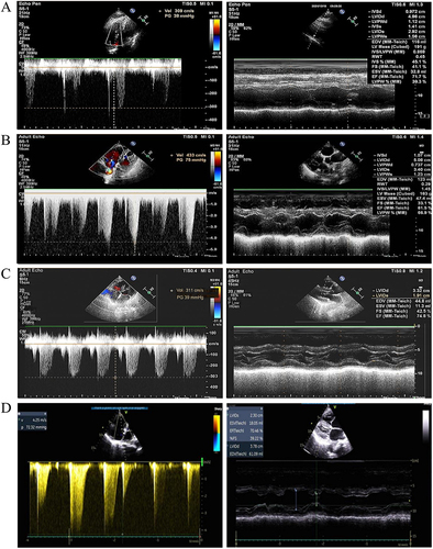 Figure 2 Echocardiography of mild and non-mild group 3 PH patients with different smoking status. (A) 70 years old male non-smokers with mild symptoms had a PASP of 43. (B) 70 years old male non-smokers with non-mild symptoms had a PASP of 85. (C) 70 years old male smokers with mild symptoms had a PASP of 44. (D) 70 years old male smokers with non-mild symptoms had a PASP of 82.