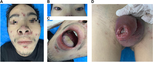Figure 1 Clinical feature. (A) The pustular rash on the face. (B) Edema and congestion in both eyes. (C) Oral ulcer. (D) Purulent urethritis accompanied by genital redness, swelling and ulceration.