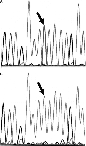Figure 2.  DNA sequence analysis. A. Normal DNA. The arrow indicates the wild-type pattern with a single thymine peak at the second nucleotide position of codon 1307.B. Patient's desmoid DNA with germ line homozygous mutation. The arrow indicates only the presence of adenine at the second nucleotide position of codon 1307.