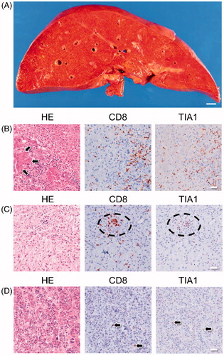 Figure 3. Gross and microscopic morphology of the liver and histology of the pituitary gland. (A) Cut surface of the liver before fixation in formalin. The liver was diffusely elastic and soft and a yellowish-red color. Bar: 10 mm. (B) Representative image of liver histology shows that most of the hepatocytes are destroyed and harbor numerous CD8-positive/TIA-1-positive lymphocytes. Arrows indicate residual hepatocytes. (C) Representative image of histology of the neurohypophysis showing infiltration of CD8-positive/TIA-1-positive lymphocytes and appearance of an abscess-like lesion (circle). (D) Representative image of histology of the adenohypophysis showing infiltration by a few CD8-positive/TIA-1-positive lymphocytes (arrows).
