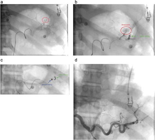 Figure 3. Transcatheter angiogram of abdomen showing (a) pseudoaneurysm (red circle), (b) placement of initial embolization coil in the branch of splenic artery distal to pseudoaneurysm, (c) placement of second embolization coil in the branch of splenic artery proximal to pseudoaneurysm, (d) Angiogram post-embolization with complete resolution of the pseudoaneurysm.