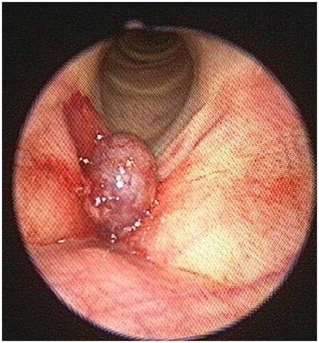 Figure 1. Fiberoptic laryngoscopic image of a right vocal cord hemangioma.