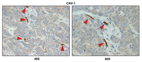 Figure 5 Cav-1 immunostaining of breast cancer-positive lymph nodes. Paraffin-embedded sections of human breast cancer-positive lymph nodes were immunostained with antibodies directed against Cav-1. Slides were then counterstained with hematoxylin. Note that Cav-1 is largely absent from the stromal compartment of positive lymph nodes, with the exception of blood vessels (indicated by red arrowheads). Two representative images are shown. Original magnification, 40x and 60x, as indicated.