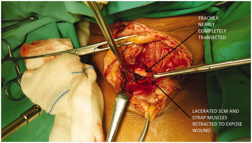 Figure 4. Intraoperative view of near complete transection of trachea.