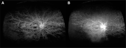 Figure 2 Optos ultrawide-field fluorescein angiogram of the same patient at arteriovenous (A) and late (B) phases.