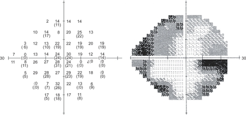Figure 1 Humphrey 24-2 visual field testing with mean deviation of −16.1; right eye.