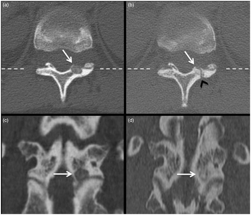 Figure 4. (a) OB of the lamina of D11 (arrow); (b) ossification of the nidus treated (arrow) with the sign of the pathway of the nidus (black arrowhead); (c, d) coronal reconstructions along the plane hatched on the axial images with evidence of ossification of the treated lesion.