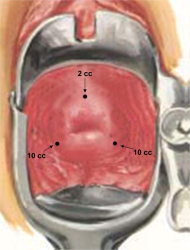 Figure 2 Intracervical block injection sites.