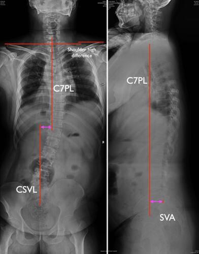 Figure 1 Radiological measurements. Radiological measurements were made on standing anteroposterior (A-P) and lateral X-ray of the entire spine. The horizontal distance of CSVL-C7PL on A-P X-ray was measured to assess coronal imbalance. The SVA was measured by the distance between C7PL and the S1 posterior-superior corner on lateral X-ray, which was used to assess sagittal imbalance. The bilateral shoulder height difference was measured on the A-P X-ray.