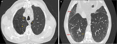 Figure 4 Radiographic findings in a 67-year-old-male active smoker patient with 100 CPY smoking history. Axial presurgical CT chest images showed advanced centrilobular (yellow arrowhead), paraseptal (yellow arrow) and bullous emphysema (asterisk) (A). (B) represented bibasilar subpleural reticular changes with traction bronchiolectasis (solid red arrow) and traction bronchiectasis (dotted yellow arrow).