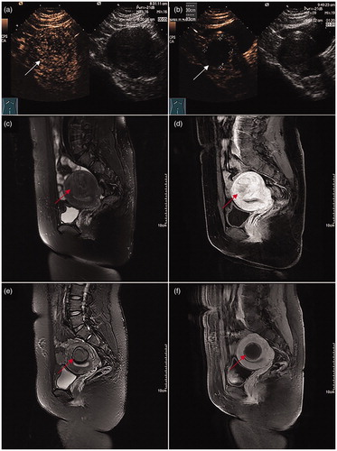 Figure 2. Images for a 28-year-old woman with two vaginal deliveries after ultrasound-guided HIFU ablation treatment for a fibroid. (a) Contrast-enhanced ultrasound (CEUS) obtained before treatment showed enhancement of the fibroid (white arrow) on the posterior wall of the uterus. (b) Immediate CEUS obtained after treatment showed a non-enhanced region (53.7 cm3). The margins of the non-enhanced region (white arrow) were shown at the ablated region. (c) and (d) Sagittal view of MRI obtained before treatment showed enhancement of the fibroid (red arrow) on the posterior wall of the uterus. (e) and (f) Sagittal view of an MRI obtained 3 months after ultrasound-guided HIFU ablation showed a decreased size of the fibroid (red arrow). The volume of the fibroid was 35.5 cm3. The woman was pregnant after 6 months and 24 months following treatment and gave birth to two healthy babies weighing 3.3 kg and 3.0 kg, respectively.
