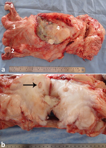Figure 19. Necropsy findings in a female camel with difficult defecation and straining. Transrectal ultrasonography showed a pelvic mass. Necropsy was performed where abscess was detected near the uterus (a), compressing the left ureter (black arrow; b) and leading to hydronephrosis of the left kidney. Other lesions were fibrinous peritonitis and pelvic adhesions. 1 = left ovary; 2 = right ovary; 3 = uterine body; 4 = abscess.