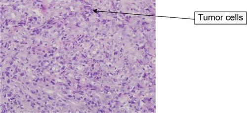 Figure 2 H&E staining of tumor cells.