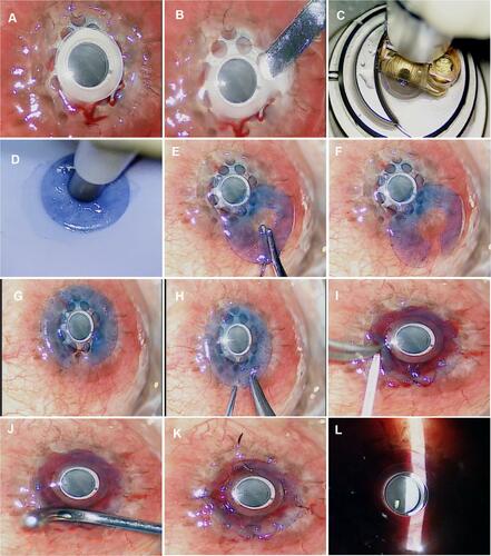 Figure 1 Surgical Technique; keyhole anterior lamellar keratoplasty for KPro corneal melt. (A) Intraoperative photograph showing significant corneal melt, almost 360 degrees around the stem and the anterior surface of the Boston KPro plate with exposure of the back plate. (B) A Crescent blade is used to remove the necrotic tissue around the KPro. (C) A microkeratome is used to create a lamellar disc from a donor cornea mounted within an artificial anterior chamber. (D) The center of the stained donor lamellar graft is trephined. (E) Westcott scissors is used to complete a radial cut between the central opening and periphery. (F) A keyhole lamellar disc is created. (G) The keyhole lamellar disc is draped around the central stem of the KPro. (H) The cut edges of the keyhole lamellar graft are approximated with interrupted 10–0 nylon sutures. (I) Fibrin glue (Tisseel) is used to attach the lamellar graft to the ocular surface. (J) A muscle hook is used to iron the lamellar graft surface to ensure uniform attachment of the donor graft to the underlying tissues. (K) The edges of the lamellar graft are further anchored to the underlying tissues with interrupted 10–0 nylon sutures. (L) Intraoperative slit-lamp view confirms uniform attachment of the keyhole lamellar graft without any debris or air bubbles in the donor recipient interface.