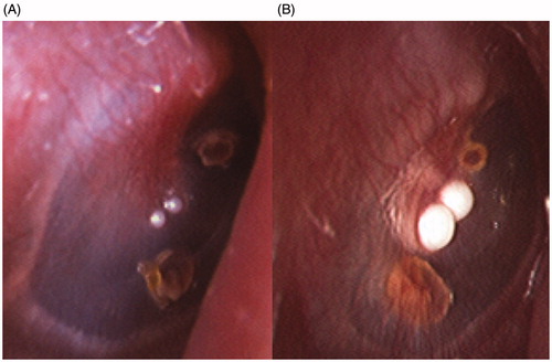 Figure 1. (A) Two masses adjacent to the umbo of the malleus. (B) Both lesions grew and eventually fused together.