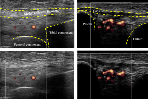 Figure 1 Representative images of power Doppler (PD) ultrasonography. The left and right images show PD grade 1 and grade 2 synovitis, respectively.