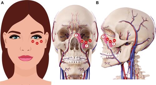 Figure 5 Codes involved in the direct approach strategy for treating tear trough deformity. Tear trough and orbital codes should be reserved for specialists specifically trained in this technique and those who have a sound knowledge of the anatomy and physiology for this particular area. Data from Peng et alCitation6 and de Maio.Citation10 Image courtesy from and reprinted with permission from Allergan plc, Dublin, Ireland. (A) Imaging representing the frontal view. (B) Imaging representing the anatomical structures. Red circle under Tt1 and exclamation mark: Be aware of the infraorbital artery branches. Red circle near to Tt3 and exclamation mark: Be aware of the angular artery and vein. Codes have been adapted from de Maio.Citation10,Citation11