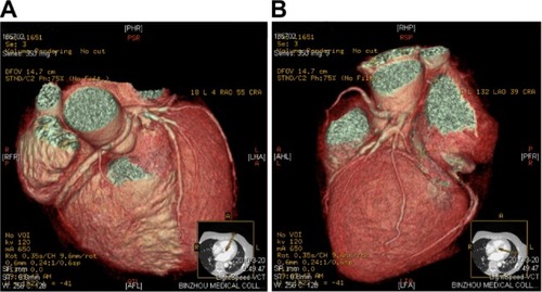 Figure 2 (A) Reconstructed three-dimensional image obtained using the volume-rendering technique shows the anomalous RCA with an interarterial course. (B) The origin of the anomalous RCA is evident.