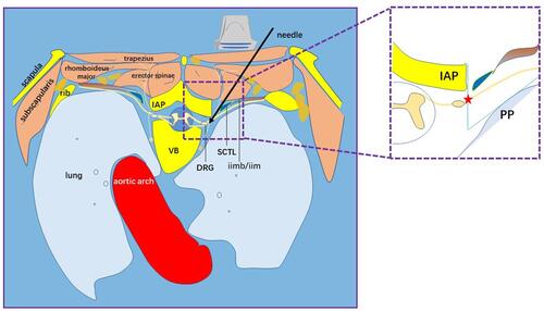 Figure 7 Schematic diagram of ultrasound-guided extraforaminal thoracic nerve root block through the midpoint of IAP-PP. The superior costotransverse ligament was not identified in the puncture process and the tip of the puncture needle was located outside the intervertebral foramen, which could avoid complications such as total spinal anesthesia as much as possible. This puncture scheme could effectively block the thoracic nerve root and even the DRG. It is an accurate clinical application of thoracic paravertebral block. In red, the pentagram is the midpoint of IAP-PP and the end point of puncture.