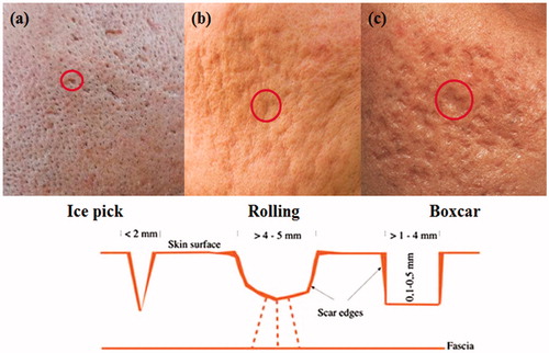 Figure 1. Types of acne scars.