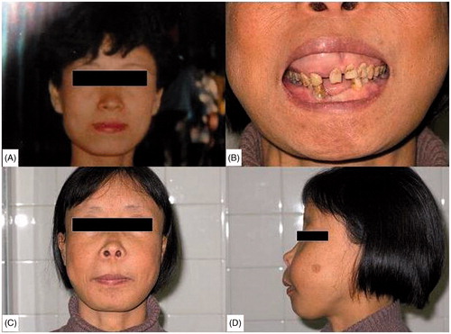 Figure 2. Facial appearance of the patient: (A) before the year of treatment with intermittent hemodialysis; (B, C, D) in the 22th year of treatment with intermittent hemodialysis.