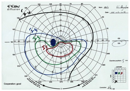 Figure 2 Goldmann’s visual field.