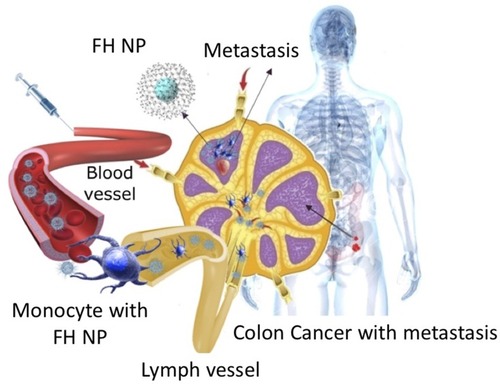 Figure 1 Following intravenous injection, FH SPIONs slowly extravasate from vascular space to interstitial space, from where they can be taken up by immune cells (monocytes/macrophages) and delivered via lymphatic vessels to lymph nodes. The FH SPIONs remain in normal nodal tissue and reduce MRI signal intensity, thereby enhancing contrast against any metastatic lesions in the node.Abbreviations: FH, Feraheme; SPIONs, superparamagnetic iron oxide nanoparticles.