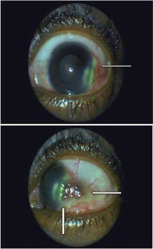Figure 2 Left eye before treatment with sulfasalazine (use of fluorescein).