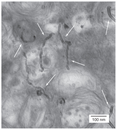 Figure 1 Transmission electronic microscopic imaging showing HeLa cells treated with functionalized multiwalled carbon nanotubes. As the white arrows illustrate, the functionalized carbon nanotubes were distributed into the cytoplasm.Citation15 Reprinted from Curr Opin Chem Biol, Vol. 9, Bianco et al, Applications of carbon nanotubes in drug delivery, pp. 674–679, Copyright (2005), with permission from Elsevier.