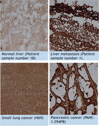 Figure 5. Expression of UCK2 in several human xenografts and tumors from patients with a different histological origin; liver metastasis of colon cancer, small cell lung cancer (H69) and pancreatic cancer..