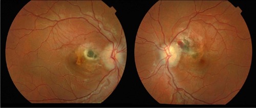 Figure 1 Fundoscopy showing granulomatous chorioretinitis and peripapillary subretinal haemorrhage in both left eye (right) and right eye (left) with subretinal haemorrhage extending to the left macula (right).
