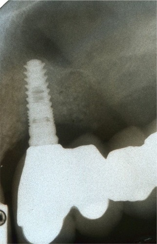 Figure 1 A 3.7×10 mm implant was placed and found to be inadequate to resist the patient’s extreme occlusal load of 1,200N.