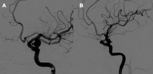 Figure 4 (A) A 49-year-old female was found to have an intracranial aneurysm located in the left internal carotid artery. No obvious stenosis was found in parent artery. The diameter of the aneurysm was more than 7 mm, and the aneurysm was found to be irregular in shape with daughter sac. (B) A 60-year-old man was found to have an intracranial aneurysm located in the left internal carotid artery. The parent artery had obvious stenosis. The diameter of the aneurysm was more than 7 mm. It was found that the aneurysm was irregular in shape with daughter sac.