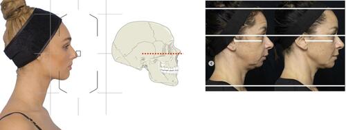 Figure 7 Illustration of the Frankfort horizontal plane, which often differs from natural head position, as viewed through a camera grid, superimposed on a skull and translated into pre-and post-photography.