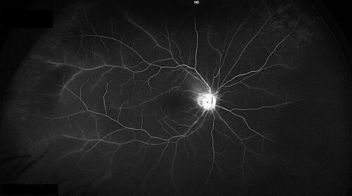 Figure 4 Right eye widefield fluorescein angiography shows peripheral pigmentary degeneration, discrete leakage and staining of the optic disc and peripapillary arterioles, taken 70 seconds after dye administration.