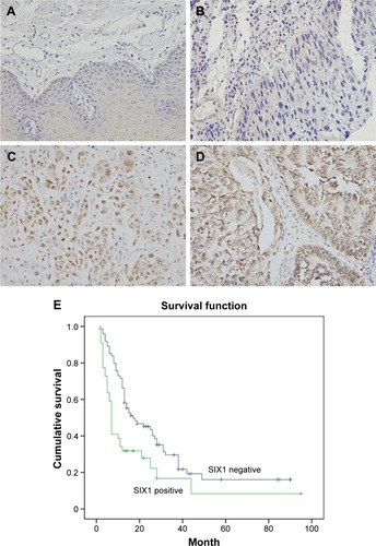 Figure 1 Expression of SIX1 protein in esophageal squamous cell carcinoma (ESCC) tissues.