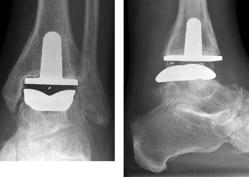 Figure 2. A Buechel-Pappas type ankle prosthesis in situ.