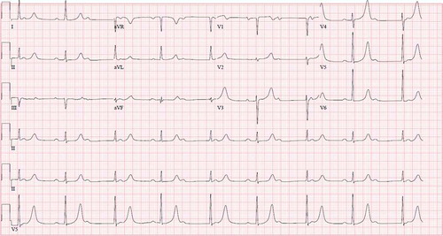 Figure 1. Complete Heart block with heart rate around 50 beats/min