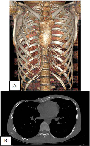 Figure 4 CT scans after operation: (A) 3D reconstruction; (B) Transversal section of thorax.