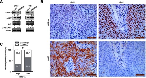 Figure 4 Silencing ARID1A was correlated with Akt pathway activation in NPC cells and clinical NPC biopsies. (A) Depletion of endogenous ARID1A by siRNA increased the phosphorylation of Akt in CNE1 and HNE1 cells. (B and C) Representative images revealed that low ARID1A expression levels were significantly associated with high p-Akt levels in NPC biopsies.#P<0.001.Abbreviations: NPC, nasopharyngeal carcinoma; ARID1A, AT-rich interacting domain-containing protein 1A.