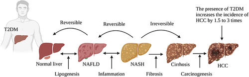 Figure 2 T2DM and obesity aggravate the progression of NAFL/NASHI to HCC. T2DM coexists with NAFLD, and it aggravates NAFLD to more severe forms of NASH, cirrhosis, and HCC.