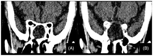 Figure 1. (A and B) CT of the nose and paranasal sinuses (coronal view): shows a hypo dense lesion occupying both sphenoid sinuses causing expansion of the sinuses. There is no destruction of the adjacent bony walls. These findings are consistent with sphenoid sinus mucocele.